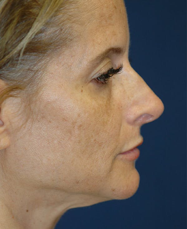 Facelift Gallery - Patient 4861586 - Image 3