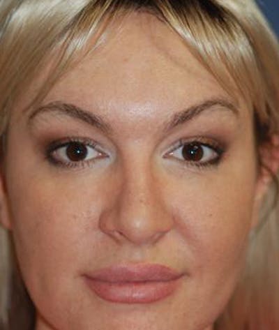 Rhinoplasty Gallery - Patient 4861589 - Image 2