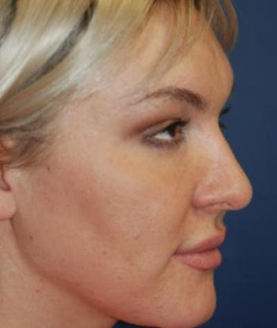 Rhinoplasty Gallery - Patient 4861589 - Image 4