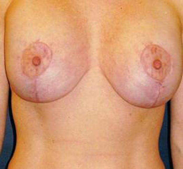 Houston Breast Lift Results