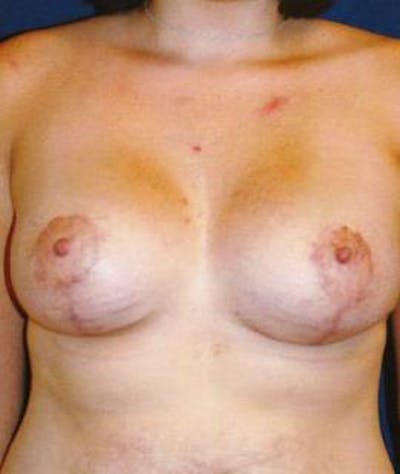 Breast Lift Gallery - Patient 4861606 - Image 2