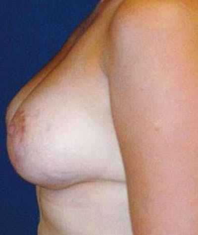 Breast Lift Gallery - Patient 4861606 - Image 4
