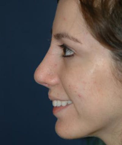 Rhinoplasty Gallery - Patient 4861609 - Image 2