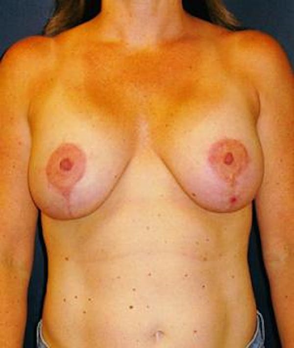 Breast Lift Gallery - Patient 4861612 - Image 2