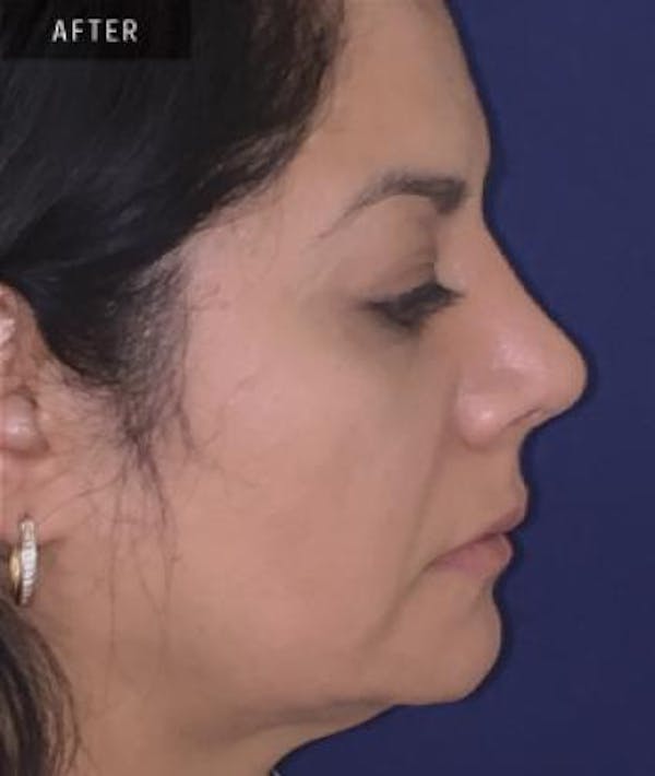 Rhinoplasty Gallery - Patient 4861614 - Image 2