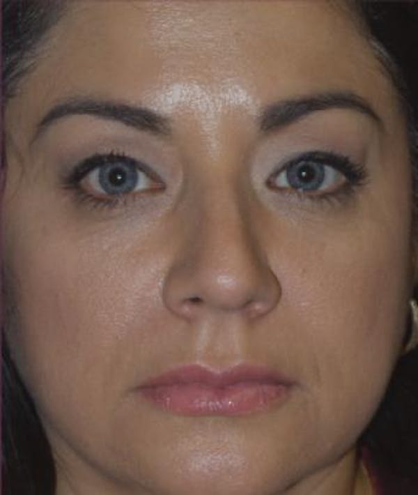 Rhinoplasty Gallery - Patient 4861614 - Image 3