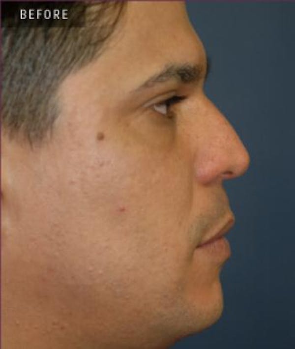 Rhinoplasty Gallery - Patient 4861615 - Image 1