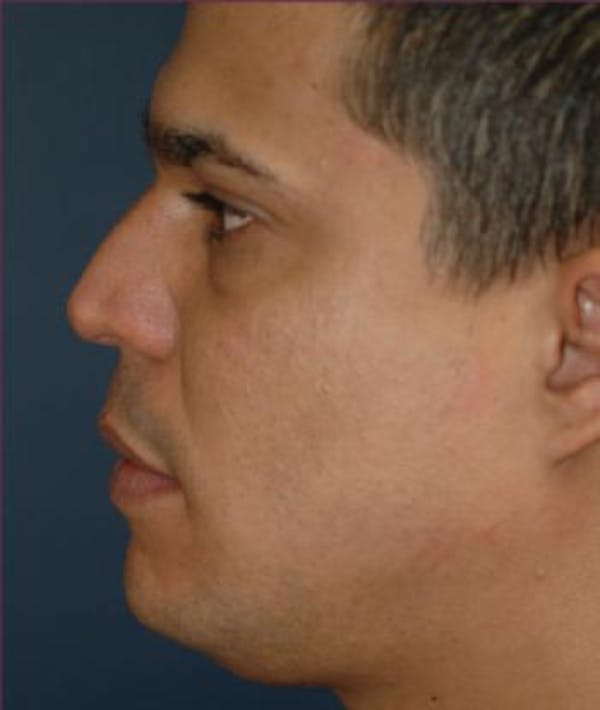 Rhinoplasty Gallery - Patient 4861615 - Image 3