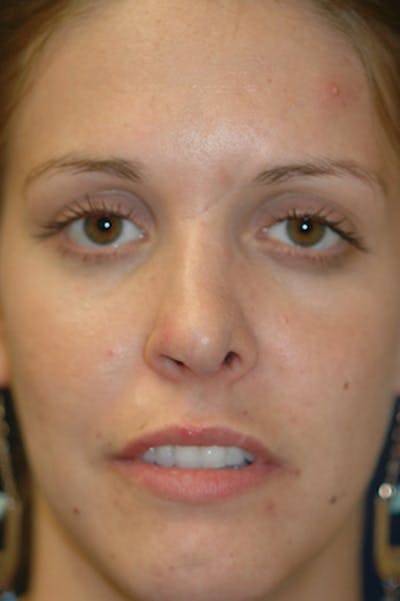 Rhinoplasty Gallery - Patient 4861627 - Image 2