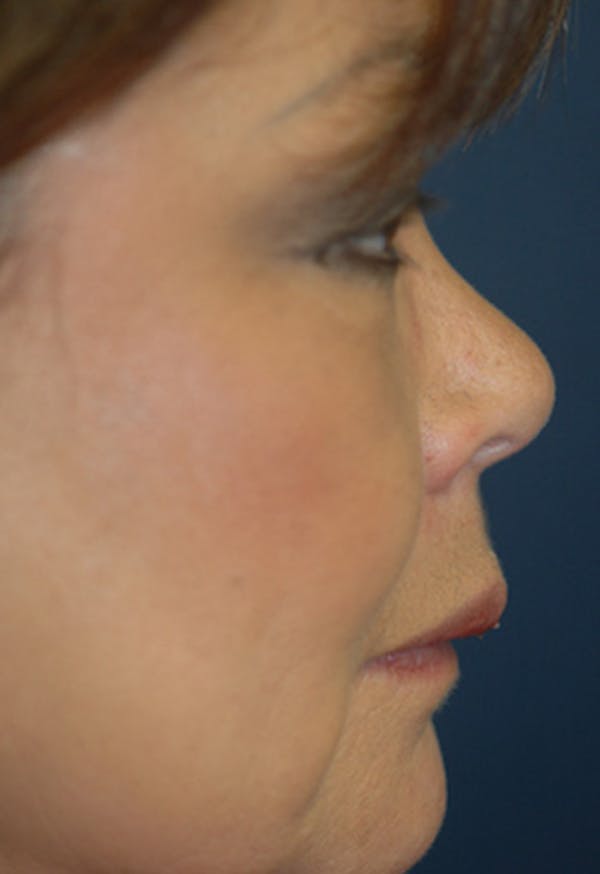 Rhinoplasty Gallery - Patient 4861628 - Image 1