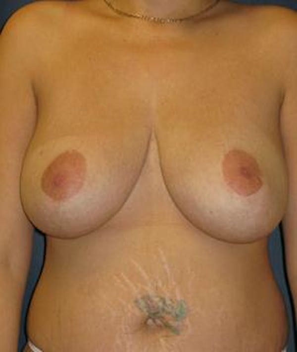 Before and After Breast Reduction in Houston