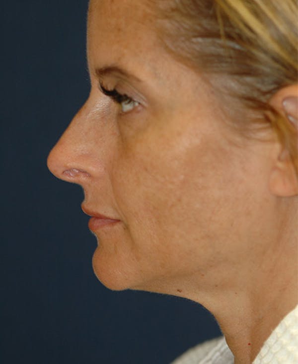 Rhinoplasty Gallery - Patient 4861638 - Image 3