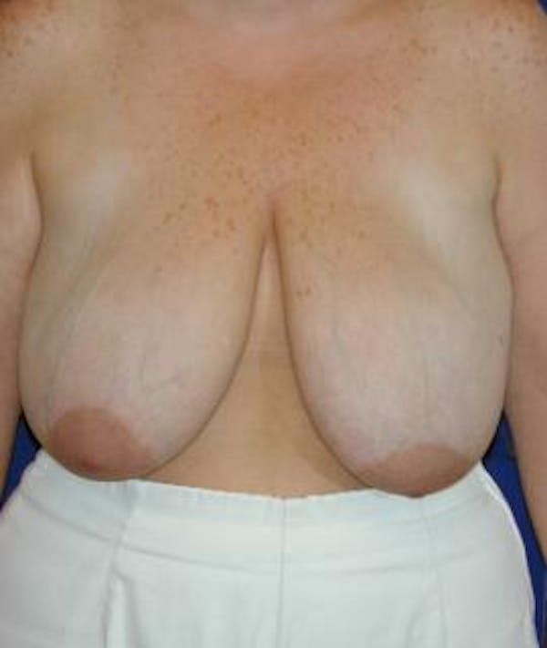 Breast Reduction Gallery - Patient 4861643 - Image 1