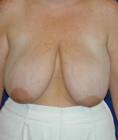Breast Reduction Gallery - Patient 4861643 - Image 1