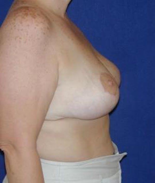 Breast Reduction Gallery - Patient 4861643 - Image 4