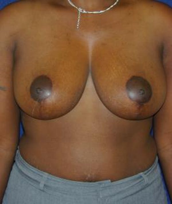 Breast Reduction Gallery - Patient 4861645 - Image 2