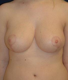 Before and After Houston Breast Reduction