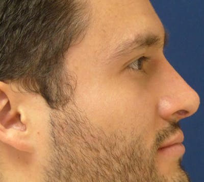 Rhinoplasty Gallery - Patient 4861653 - Image 6