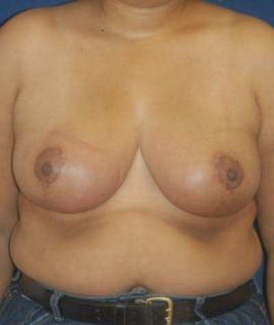 Breast Reduction Gallery - Patient 4861655 - Image 2
