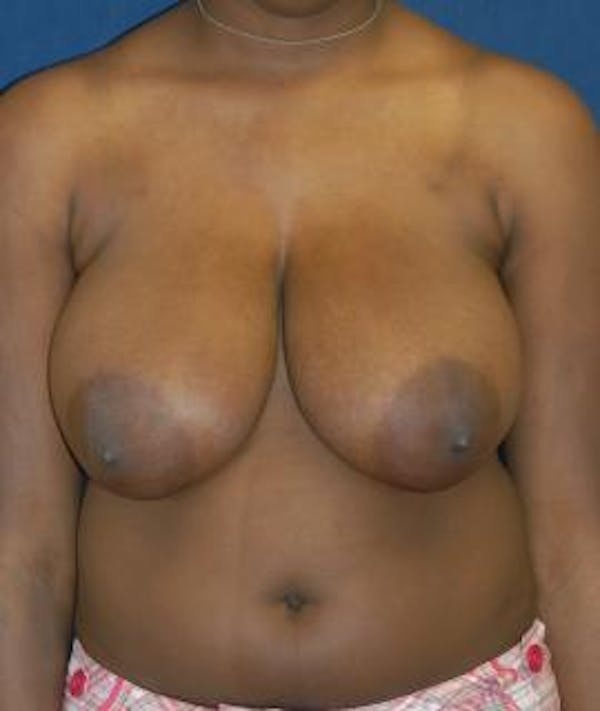 Breast Reduction Gallery - Patient 4861735 - Image 1