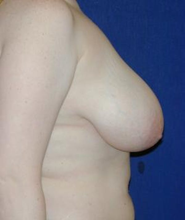 Breast Reduction Gallery - Patient 4861736 - Image 3