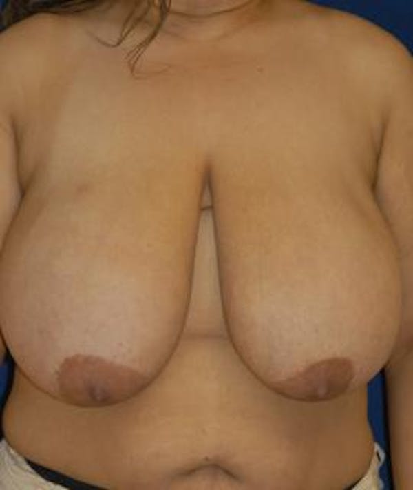 Breast Reduction Gallery - Patient 4861739 - Image 1