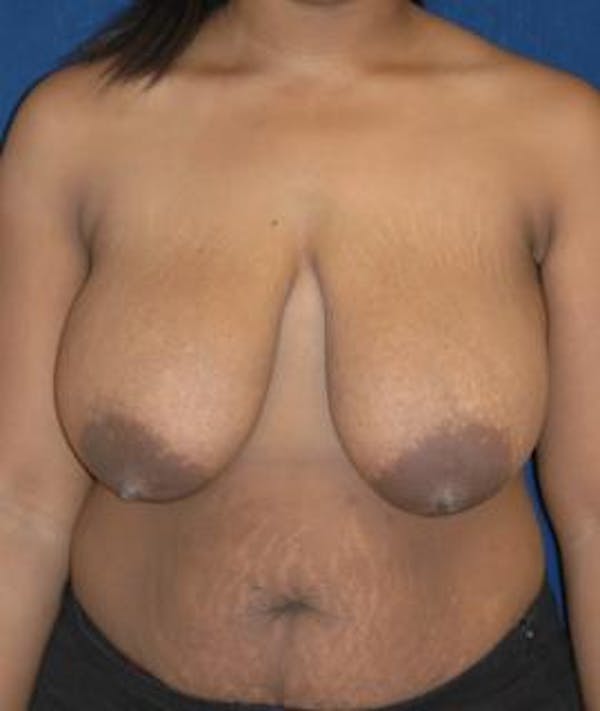 Breast Reduction Gallery - Patient 4861740 - Image 1