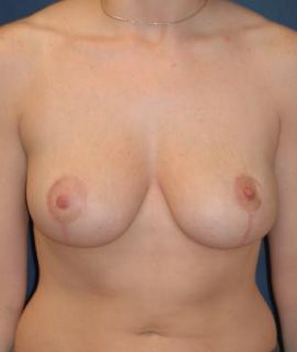Breast Reduction Gallery - Patient 4861742 - Image 2