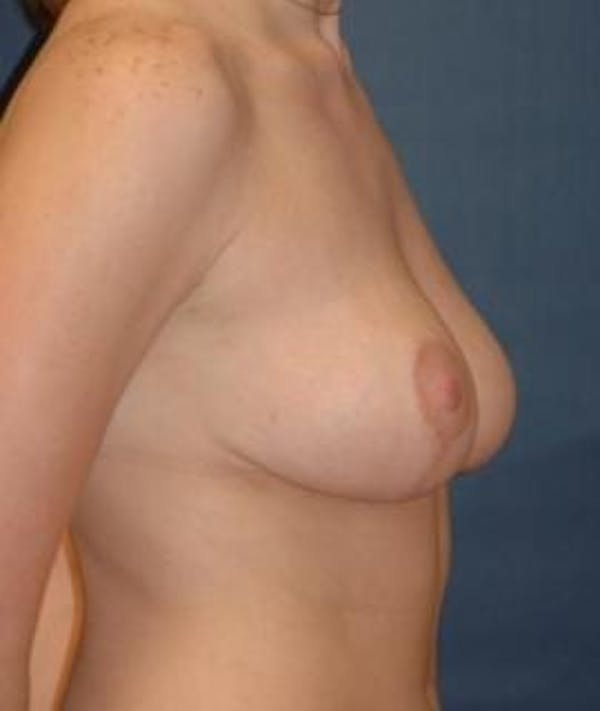 Breast Reduction Gallery - Patient 4861742 - Image 4
