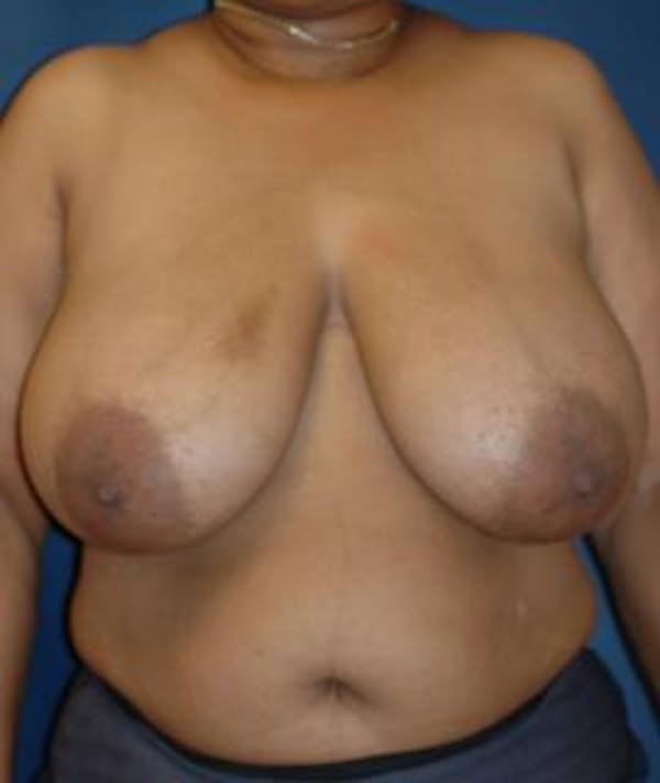 Breast Reduction Gallery - Patient 4861746 - Image 1