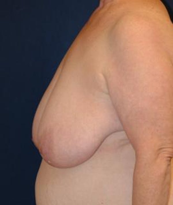 Breast Reduction Gallery - Patient 4861748 - Image 3