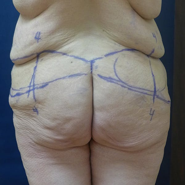 Body Lift Gallery - Patient 4861750 - Image 3