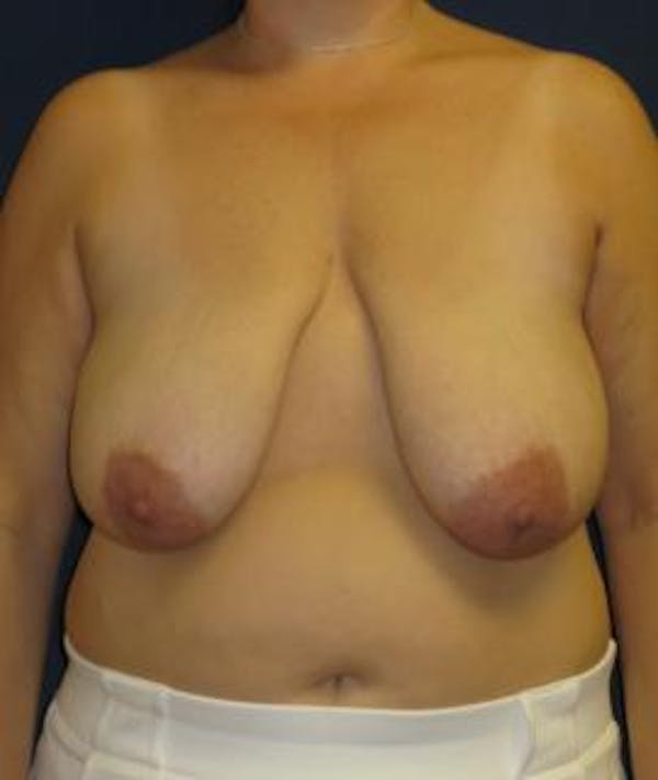 Breast Reduction Gallery - Patient 4861753 - Image 1