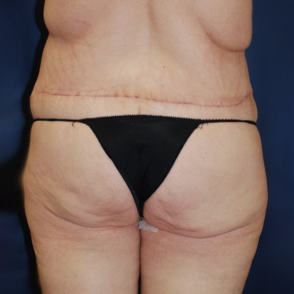 Body Lift Gallery - Patient 4861750 - Image 4