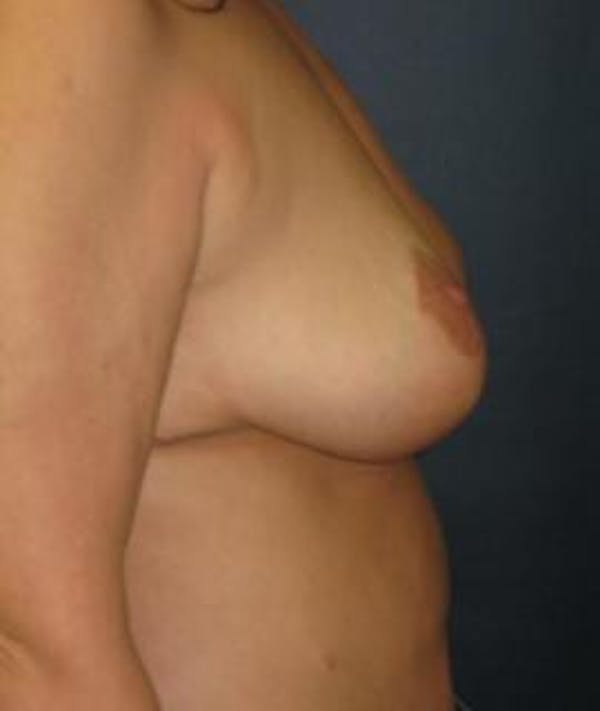 Breast Reduction Gallery - Patient 4861753 - Image 4