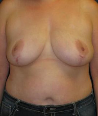Breast Reduction Gallery - Patient 4861756 - Image 2