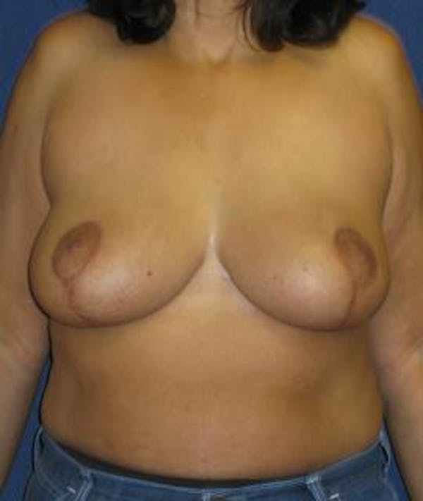 Breast Reduction Gallery - Patient 4861760 - Image 2