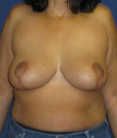 Breast Reduction Gallery - Patient 4861760 - Image 2