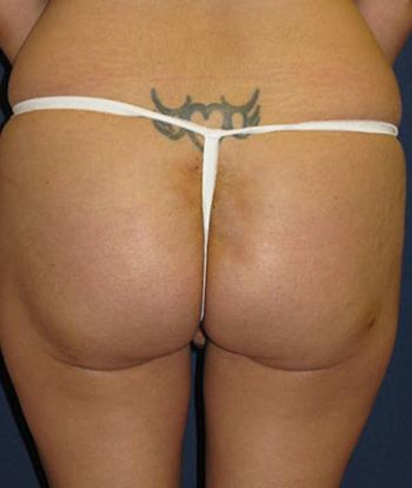 Before and After Butt Augmentation in Houston 01
