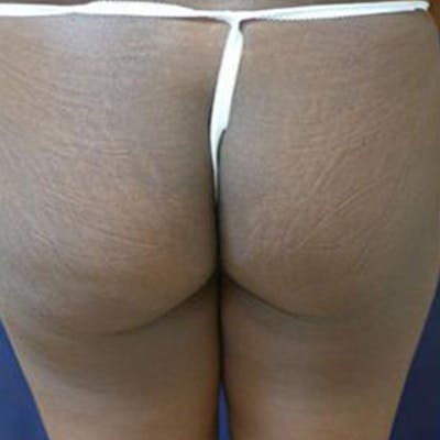 Buttock Lift Gallery - Patient 4861764 - Image 1