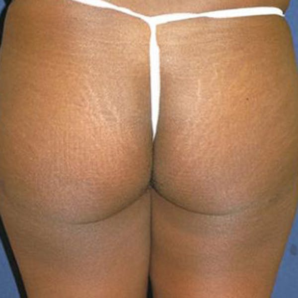 Buttock Lift Gallery - Patient 4861764 - Image 2