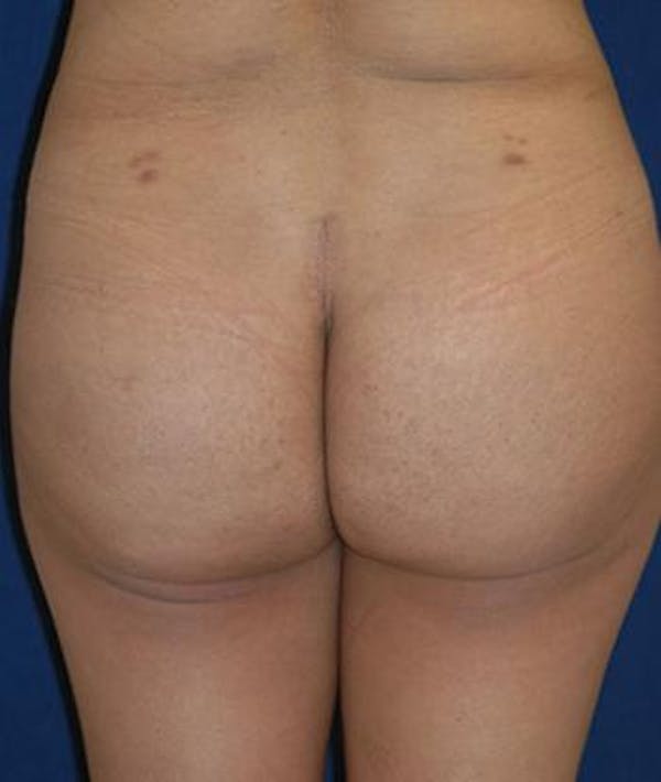 Buttock Lift Gallery - Patient 4861766 - Image 2