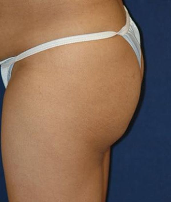 Buttock Lift Gallery - Patient 4861766 - Image 3
