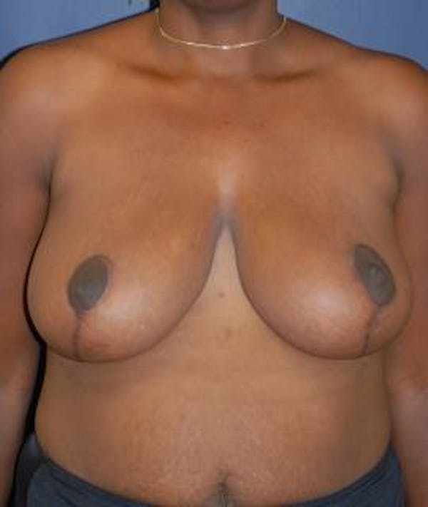Breast Reduction Gallery - Patient 4861767 - Image 2