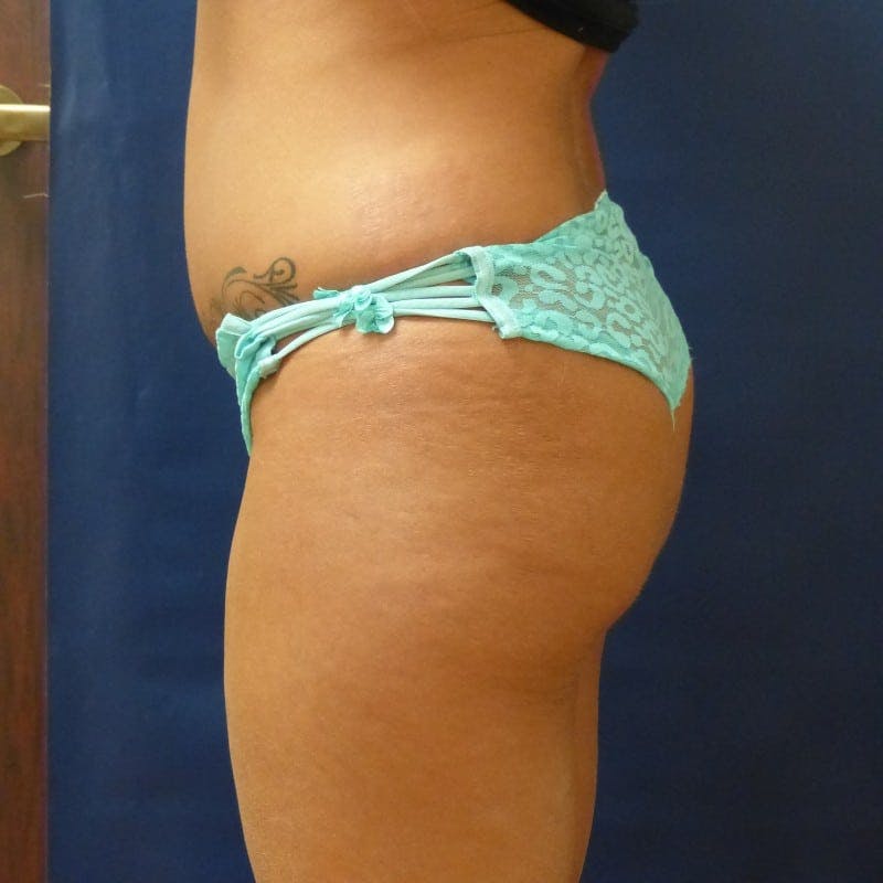 Before and After Butt Augmentation in Houston 02