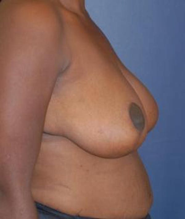 Breast Reduction Gallery - Patient 4861767 - Image 3