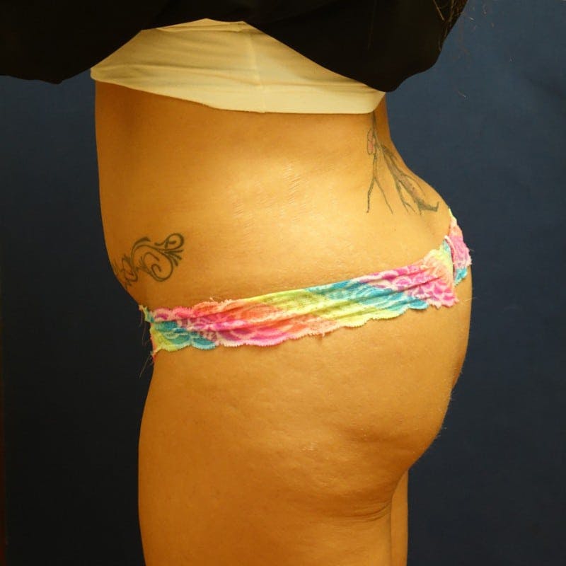 Before and After Butt Augmentation in Houston 02