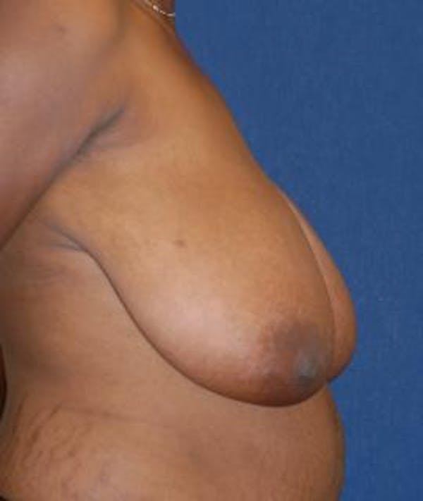 Breast Reduction Gallery - Patient 4861767 - Image 4