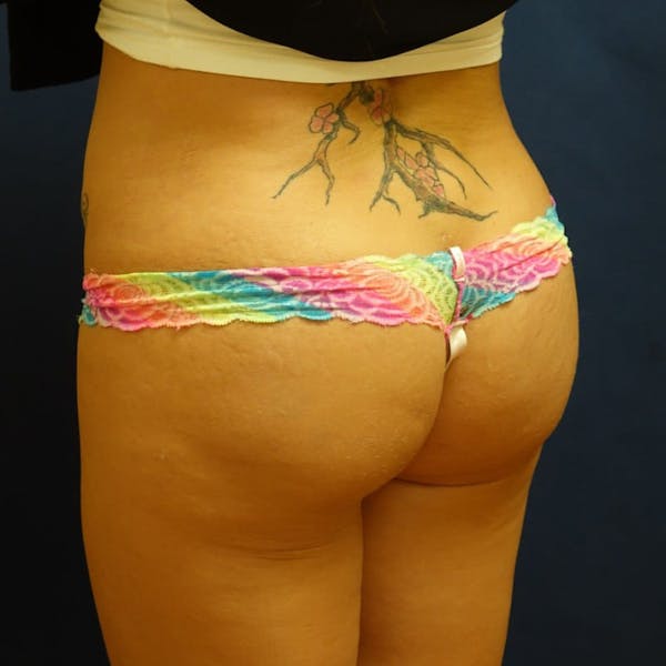 Buttock Lift Gallery - Patient 4861769 - Image 4