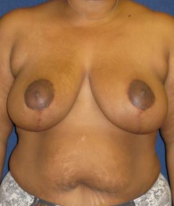 Breast Reduction Gallery - Patient 4861770 - Image 2